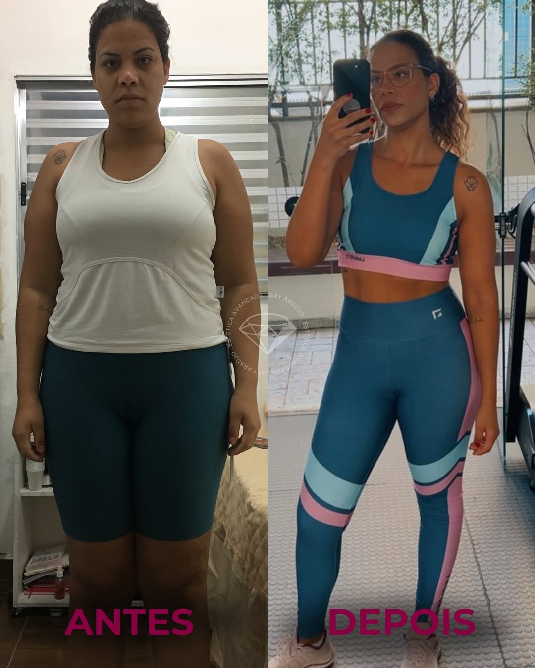 Antes e depois real do Crioshaper