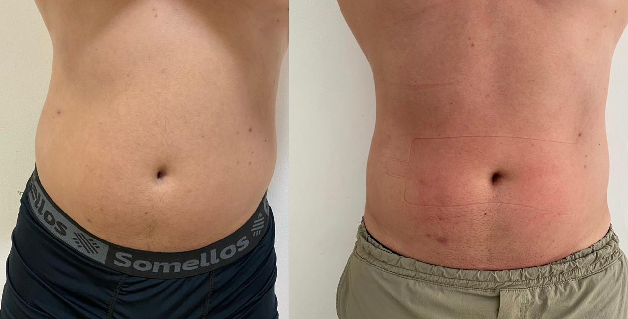 Resultado Crioshaper em homem 3